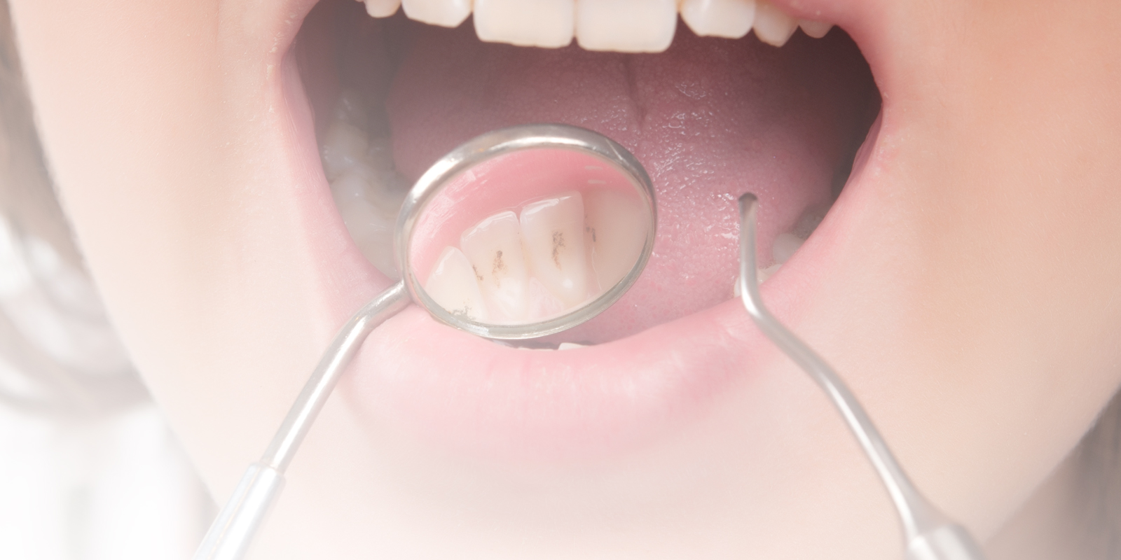 Composite Dental Fillings I Am Dental