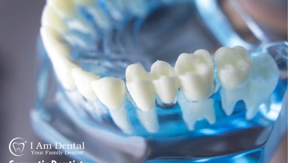 Dental Implants | Surgery, Advantages, Risks, and Insurance.