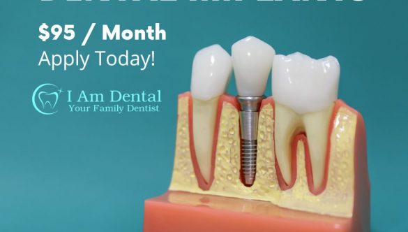 Dental Implants Offer | Starting at 95$ a month