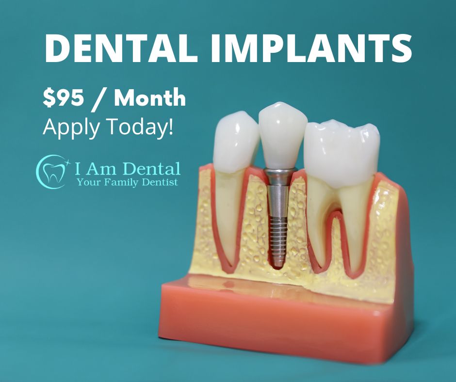 Dental Implants Offer | Starting at 95$ a month